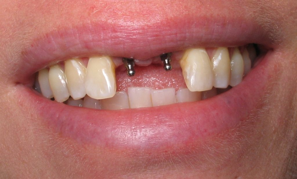 Имплантация зубов 1
